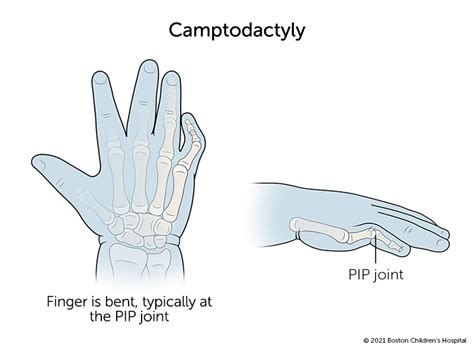 pinay finger pink|Pinky Finger Anatomy, Function & Diagram .